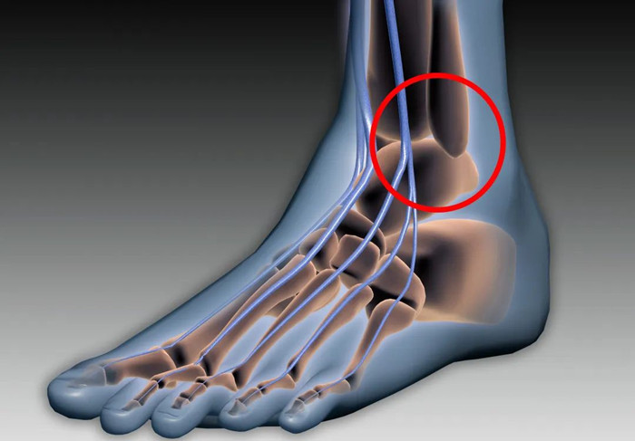 【醫(yī)療科普】:下脛腓關(guān)節(jié)復(fù)位 【醫(yī)療科普】:下脛腓關(guān)節(jié)復(fù)位