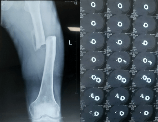 大平板一體式C形臂術前檢查 大平板一體式C形臂術前檢查