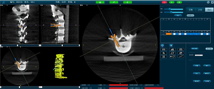 PL300B骨科手術機器人 PL300B骨科手術機器人