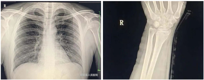 動(dòng)態(tài)DR影像 動(dòng)態(tài)DR影像